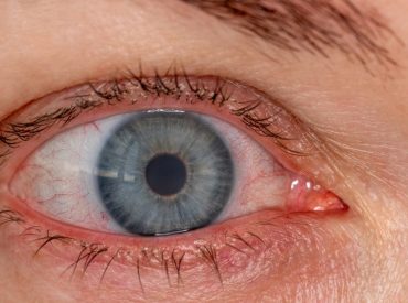 Ask a doc: ‘Why are my eyes often bloodshot?’