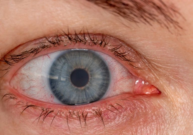 Ask a doc: ‘Why are my eyes often bloodshot?’