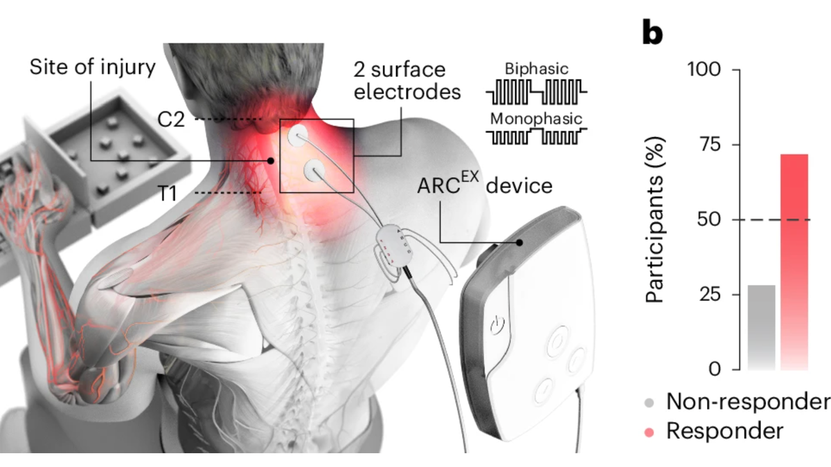 Spinal cord treatment restores function for paralyzed patients in study: ‘New hope’